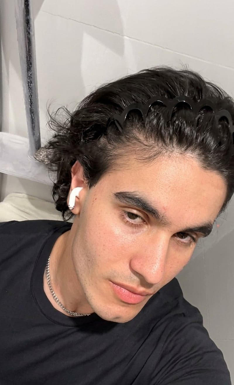 Photo after: hairline recovered, higher HairCount